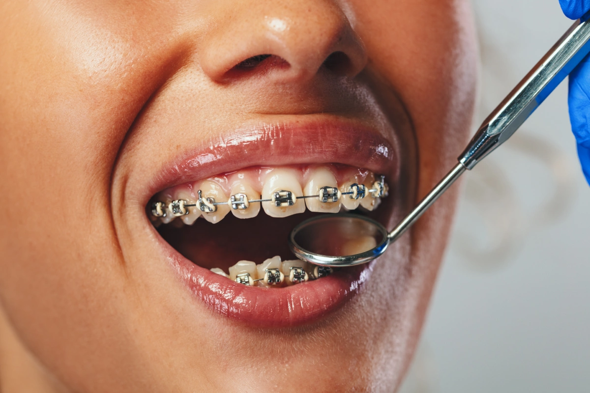 Close-up of dental examination showing patient with metal braces during orthodontic checkup with dentist mirror.