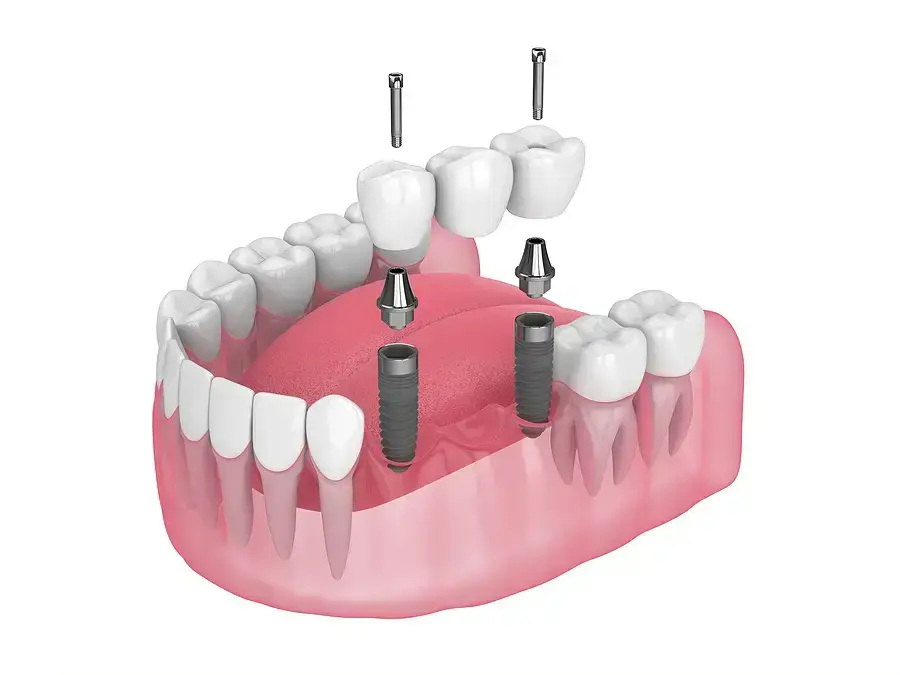 3D illustration of dental implants in upper and lower jaw with crown restorations and abutments.