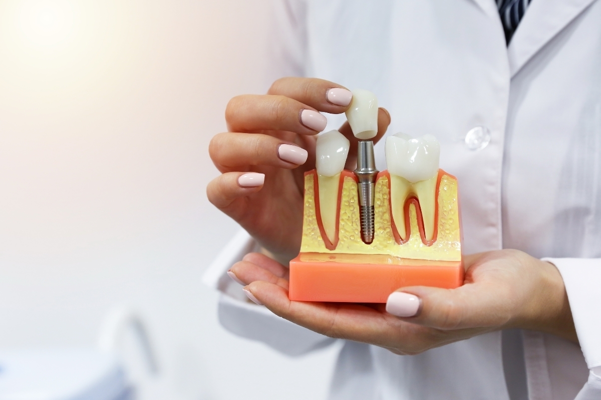 Dentist holding dental implant model showing tooth replacement with crown and screw.
