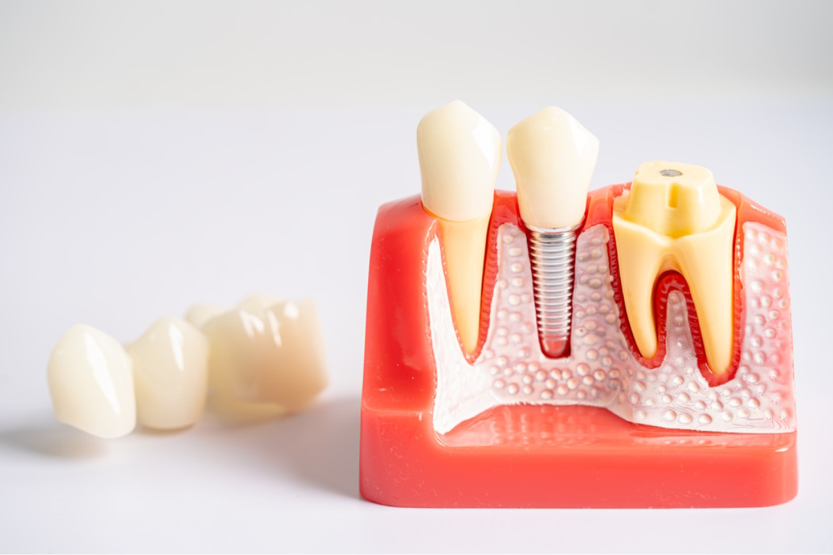 Dental implant model showing tooth replacement with crown, abutment, and fixture compared to bridge alternatives.