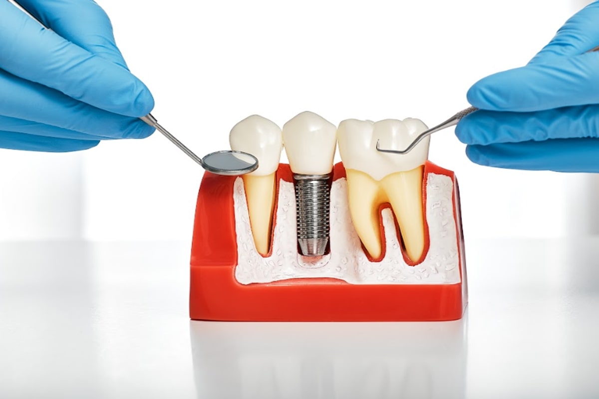Care for Your Implants After Surgery