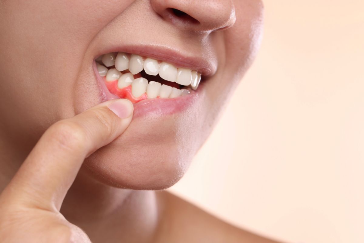 Woman pointing to inflamed gum tissue showing signs of gum disease.