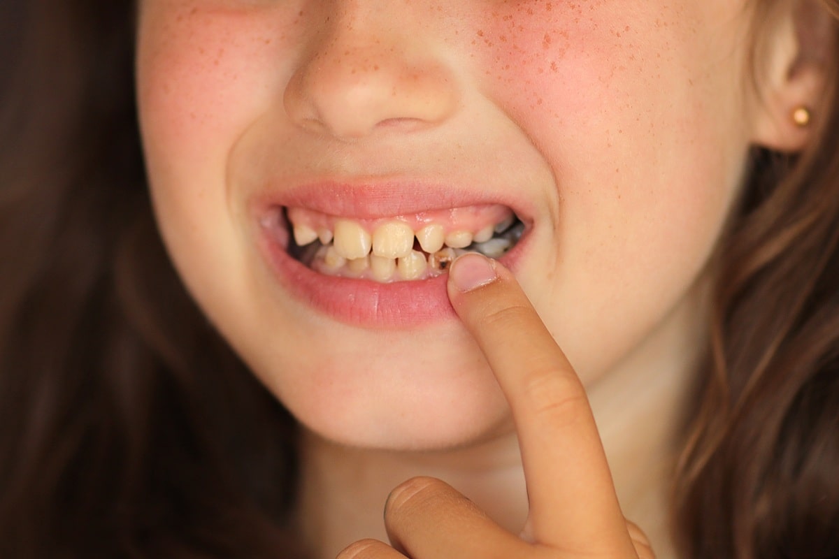 How Fast Can a Tooth Infection Spread