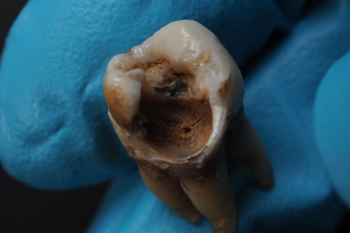 Decayed tooth showing brown discoloration and cavity development during dental examination.
