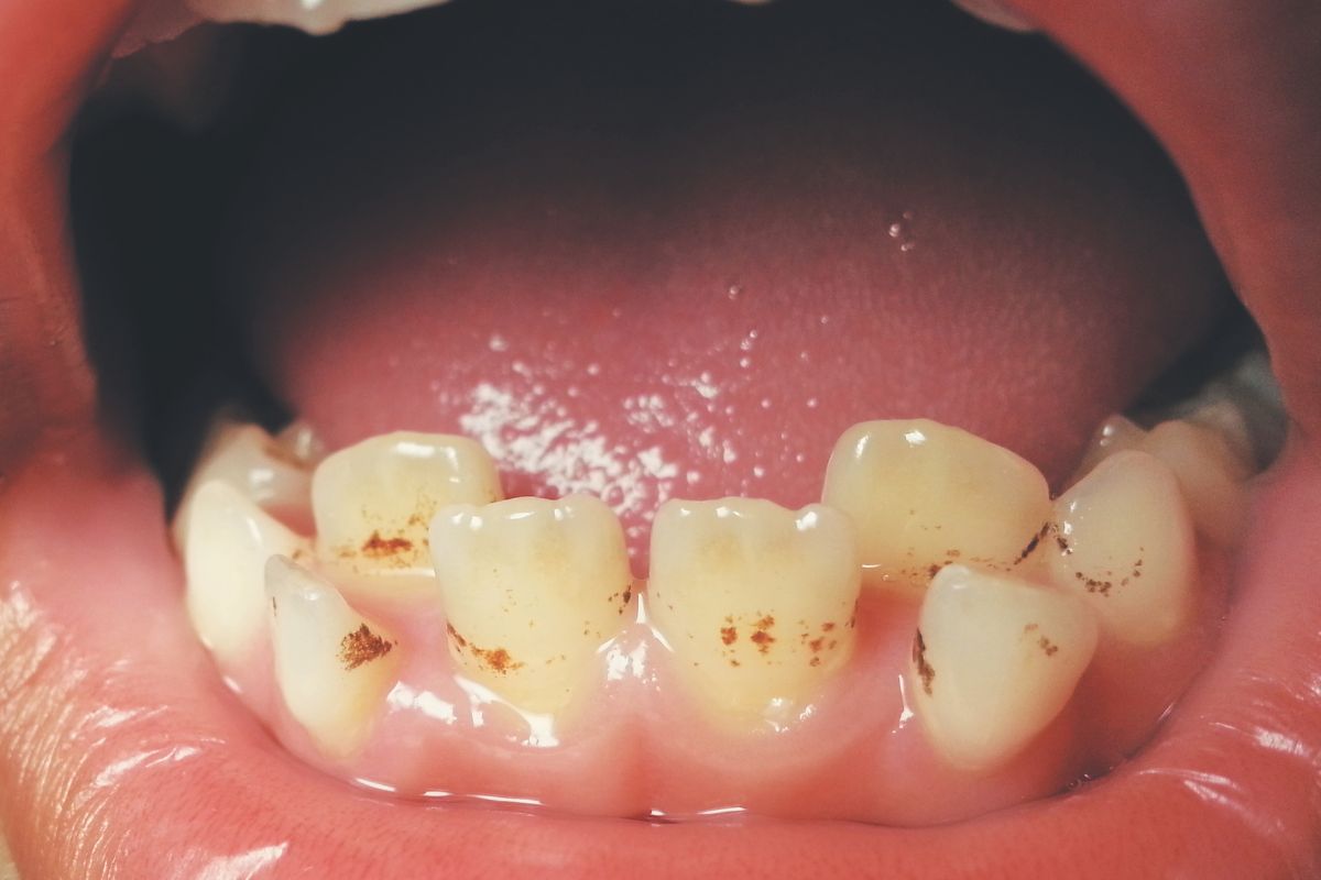 How To Get Rid Of Brown Spots On Teeth