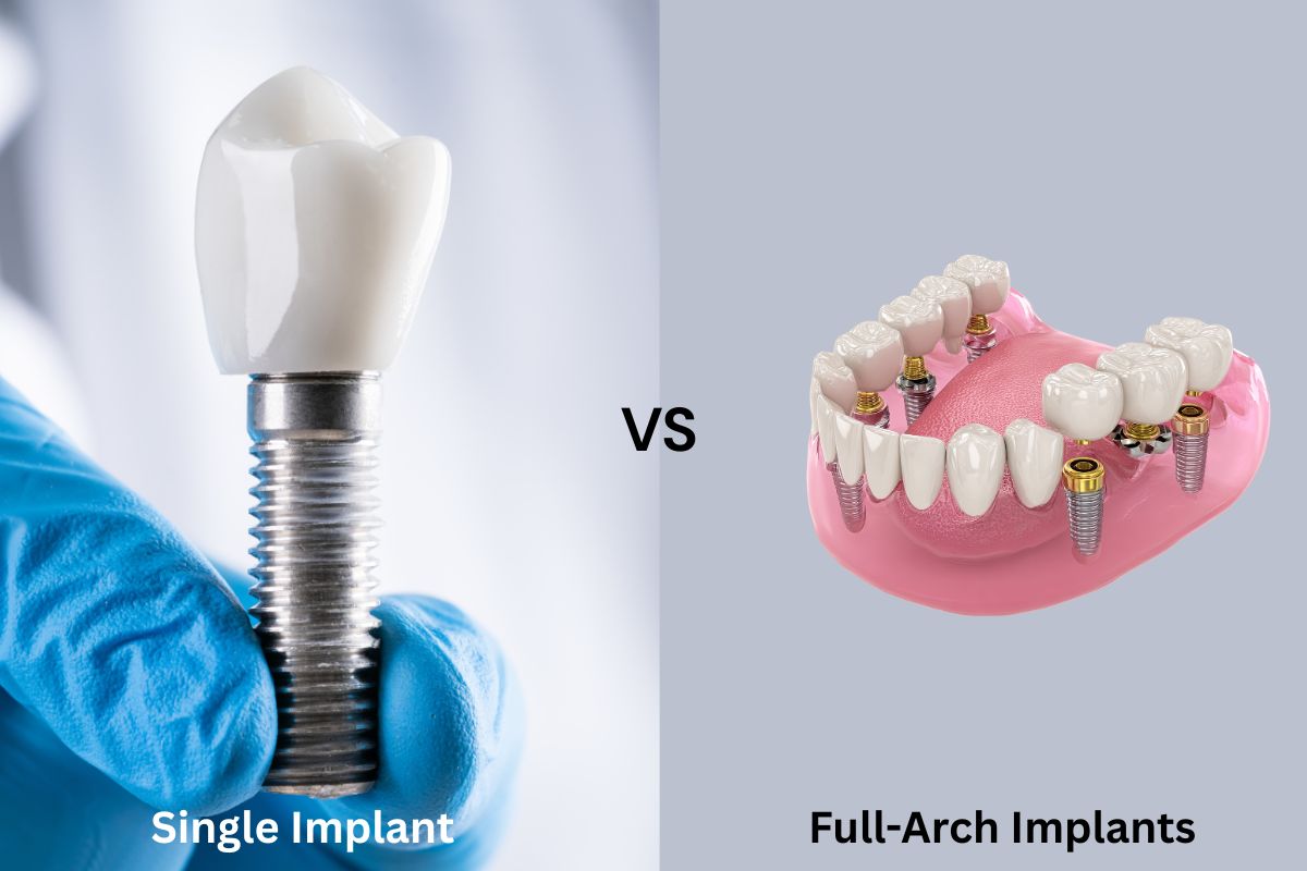 Single Vs Full Arch Implants