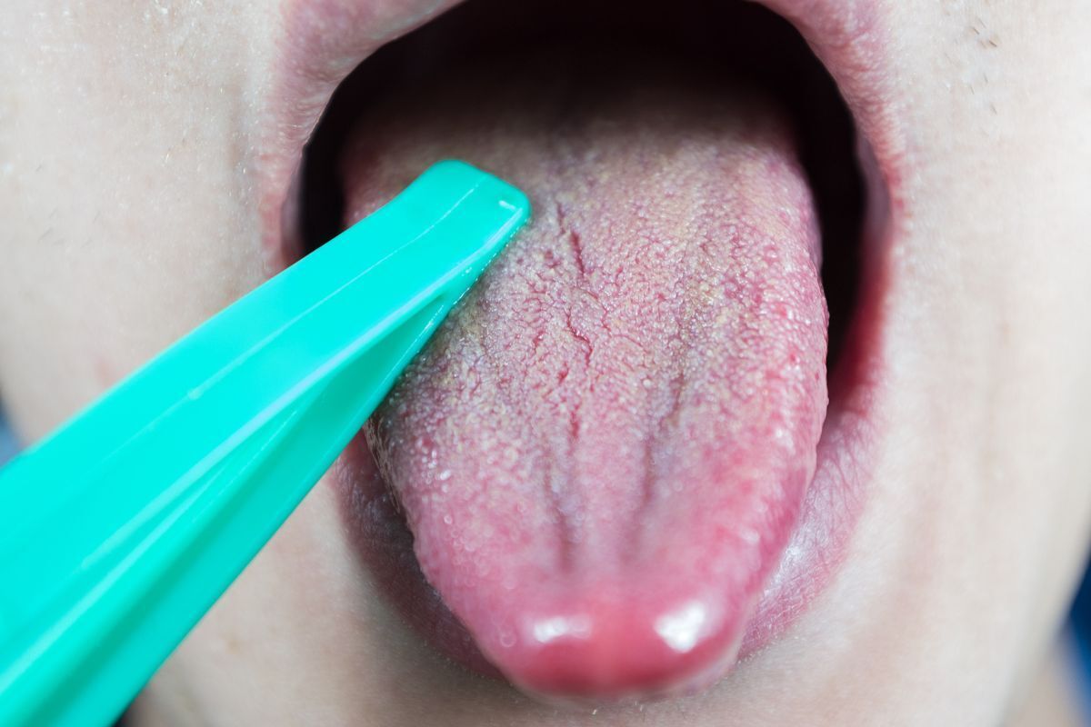Close-up of tongue being scraped with turquoise tongue scraper during dental examination.