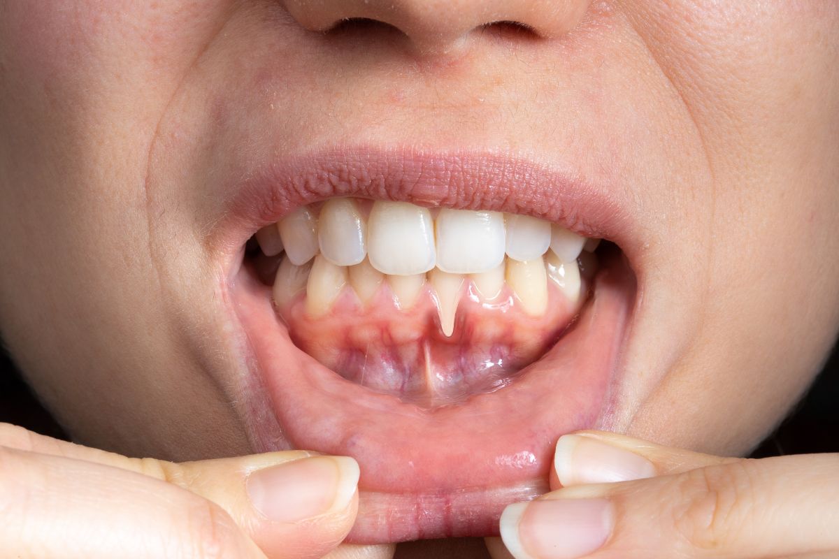 Understanding and Treating Gum Recessio