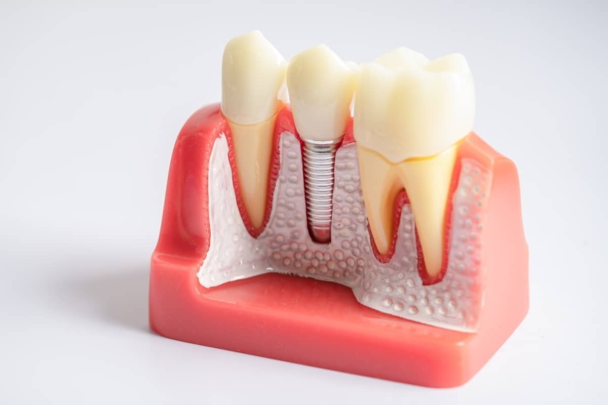 Dental implant model showing tooth replacement with metal screw and crown between natural teeth.