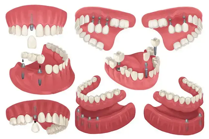 Dental Implants in Woodbridge