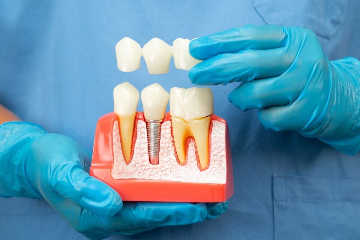Dental implant model showing tooth replacement options with crown and implant fixture for patient education.