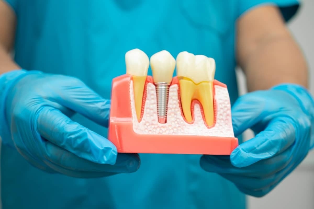 Dental implant model showing crown, abutment, and screw placement in jawbone structure.