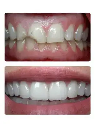 Smile Makeover in Woodbrid
