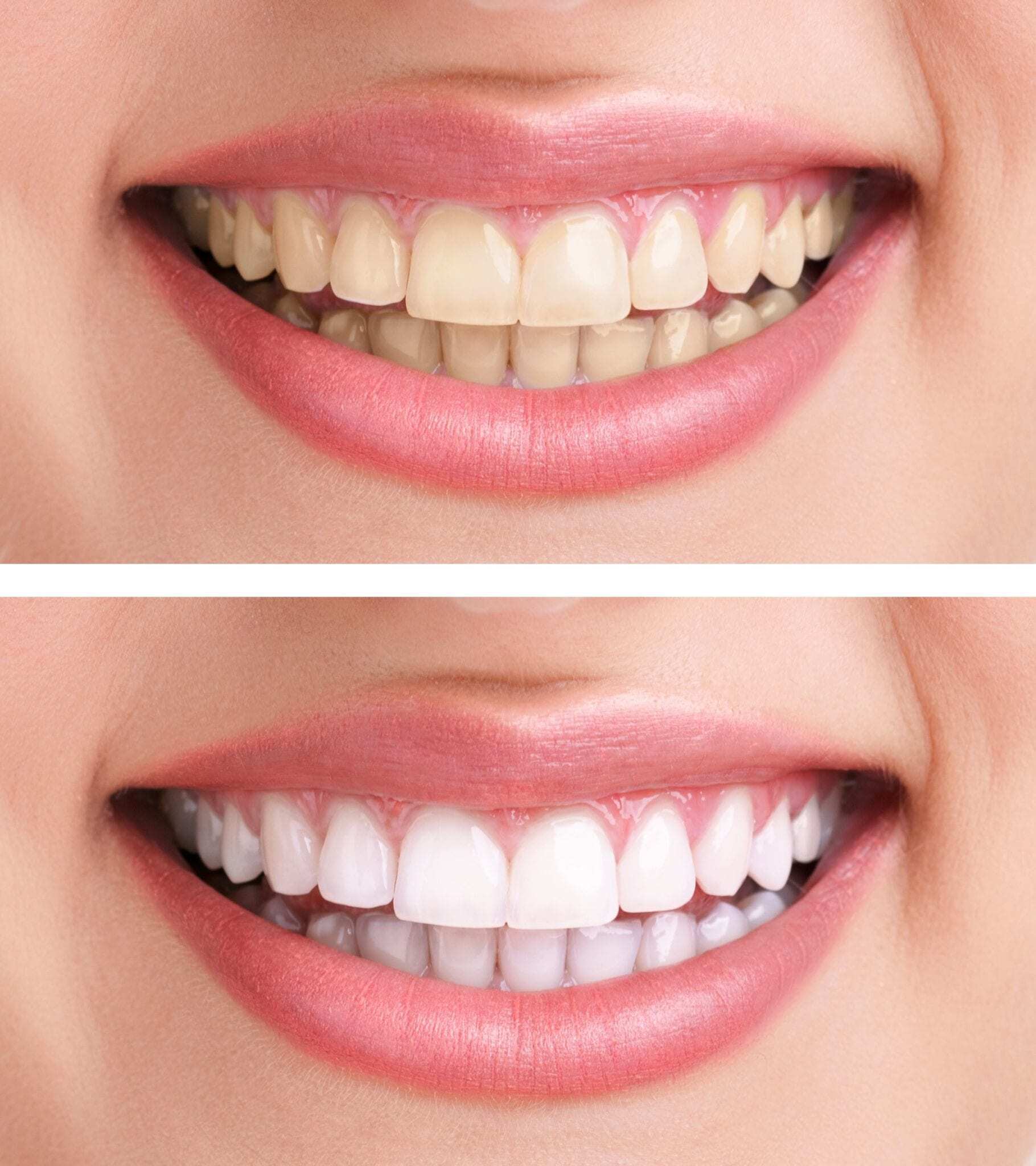 Teeth Whitening in Woodbridge