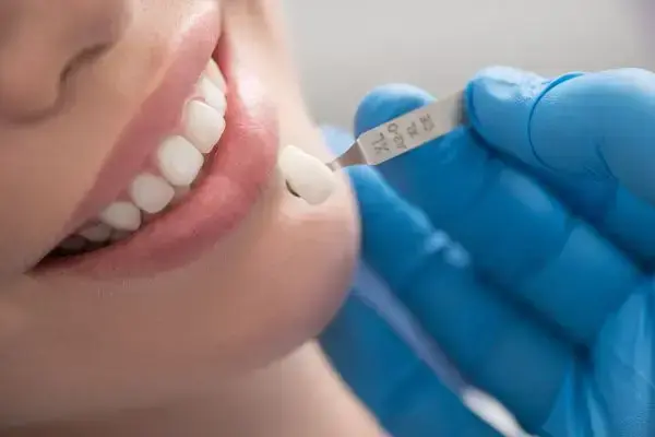 Veneers in Woodbridge