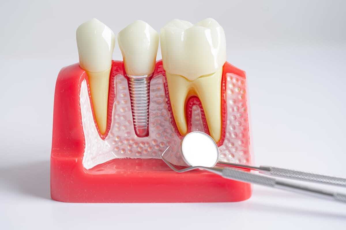 Dental implant model showing healthy tooth, implant with screw, and natural tooth with examination mirror.