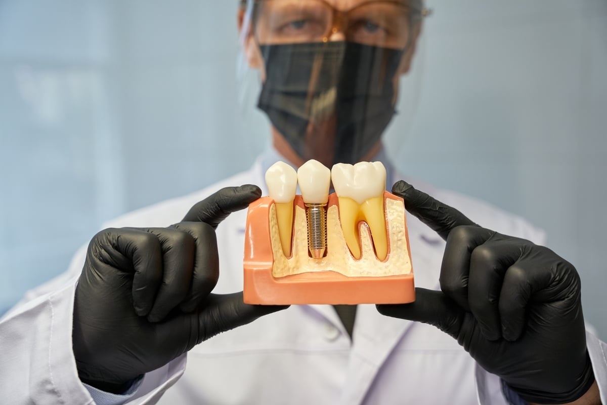 Dental Implant Abutments