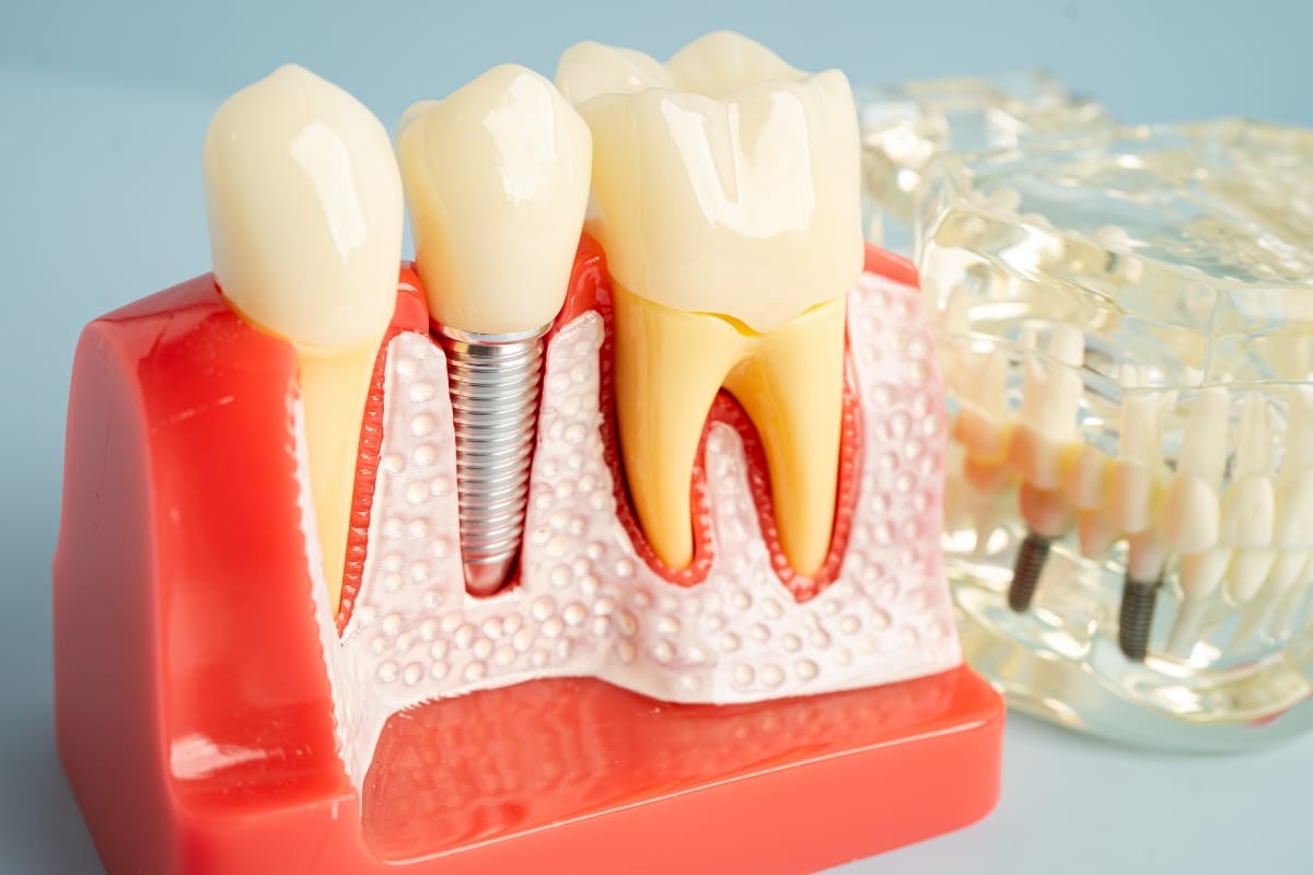 Different Types of Dental Implants