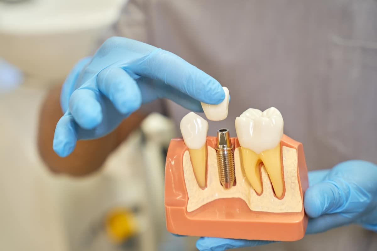 Replacing a Missing Tooth in Woodbridge