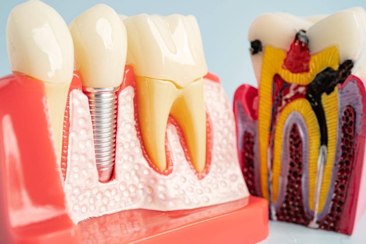 Dental Implant or Extraction? What Happens After a Severely Damaged Tooth?